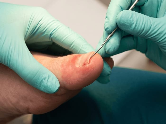 Sonda podológica removendo a espícula na lateral da unha do dedão, com a pele ao redor inflamada