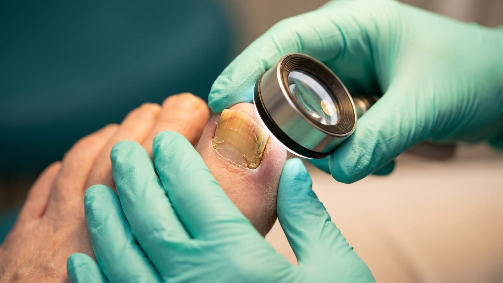 Podóloga examinando com dermatoscópio uma unha do dedão com onicomicose, espessada e amarelada
