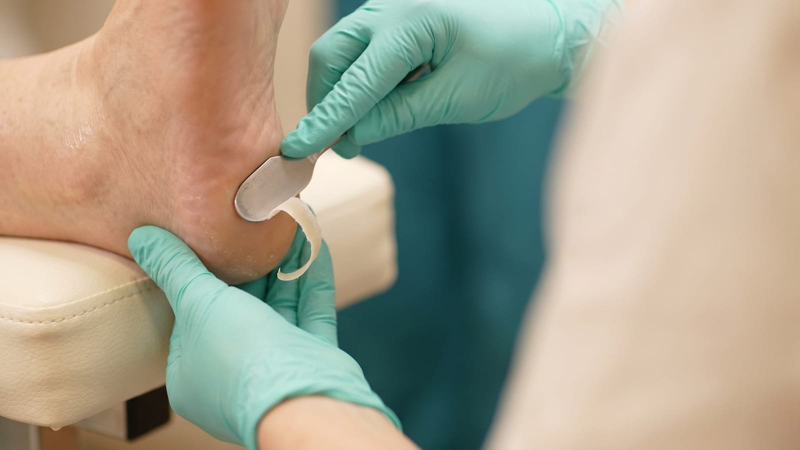 Podóloga removendo com cureta a camada de pele amolecida do calcanhar após o peeling