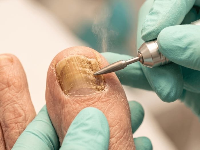 Unha do dedão sendo examinada com dermatoscópio, mostrando leve alteração de cor